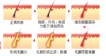 正确诊断毛囊炎的方式
