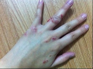 湿疹    三, 慢性湿疹症状:常常因为急性,亚急性湿疹久治不愈而转为
